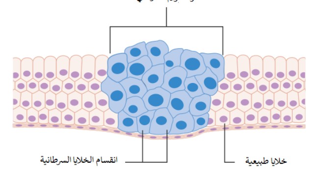 ما هو السرطان