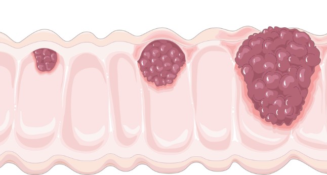 سرطان القولون: الدليل الشامل