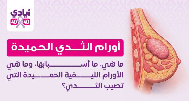 أورام الثدي الحميدة